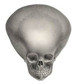 Deformed Skull